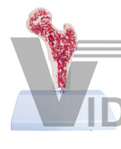 The model of thighbone pathology